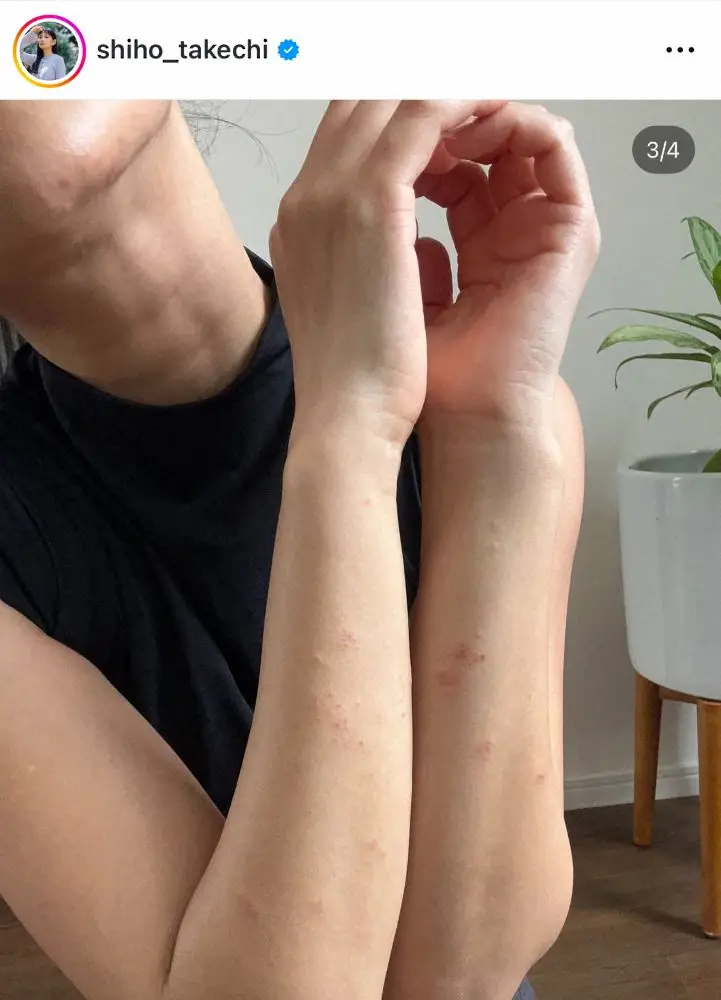 【画像・写真】39歳モデル、突然の全身湿疹　まさかの原因発覚「呼吸困難も…不妊も関係」病院で診断が困難…注意喚起