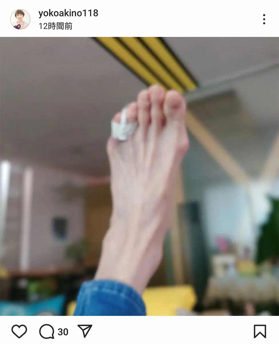 【画像・写真】秋野暢子　3年ぶりの骨折報告「小指の惨敗です」　今月“5回目の手術”から退院したばかり