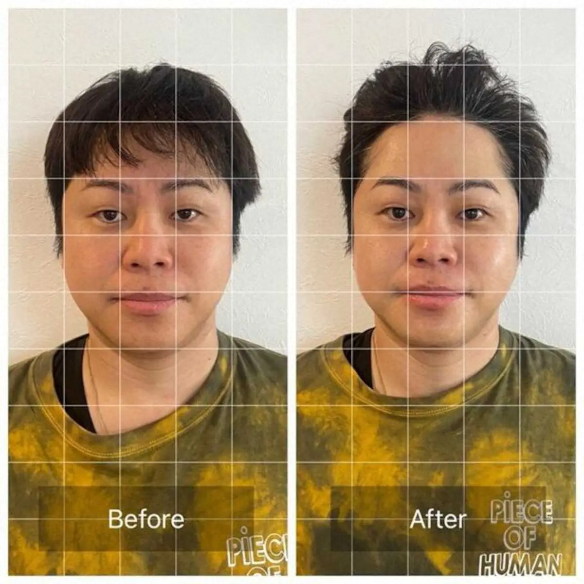 【画像・写真】顔の美容施術を受け、ビフォーアフターの写真を公開したノンスタイルの井上裕介（ブログ　https://ameblo.jp/inouenonstyle/から）