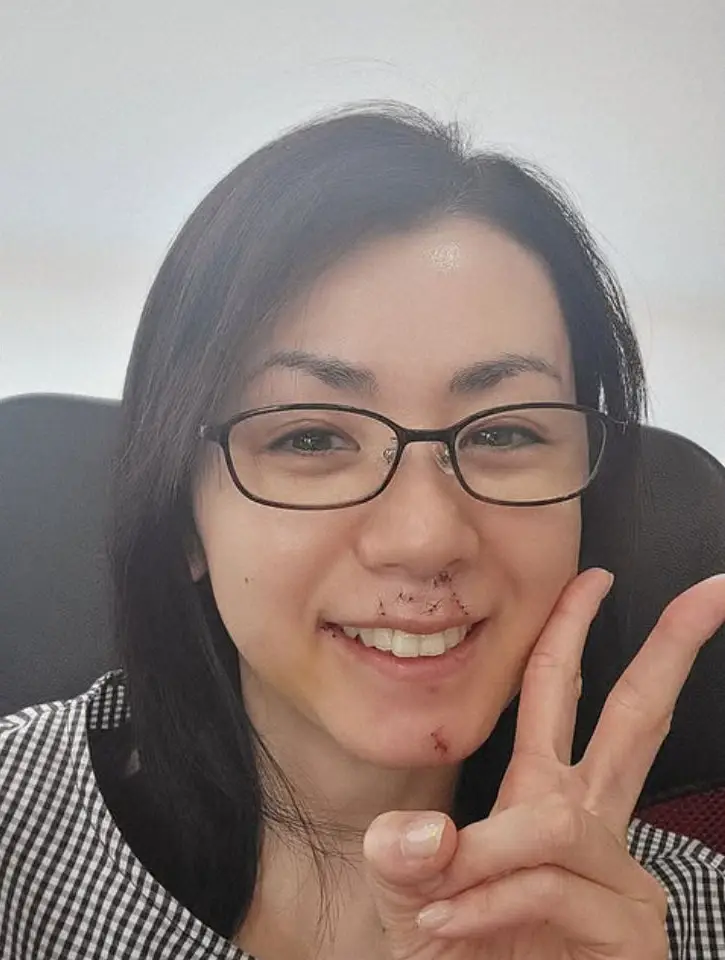 【画像・写真】小島可奈子　犬に顔をかまれ傷だらけに　30針縫う大ケガも「不思議とそんなに痛みない」