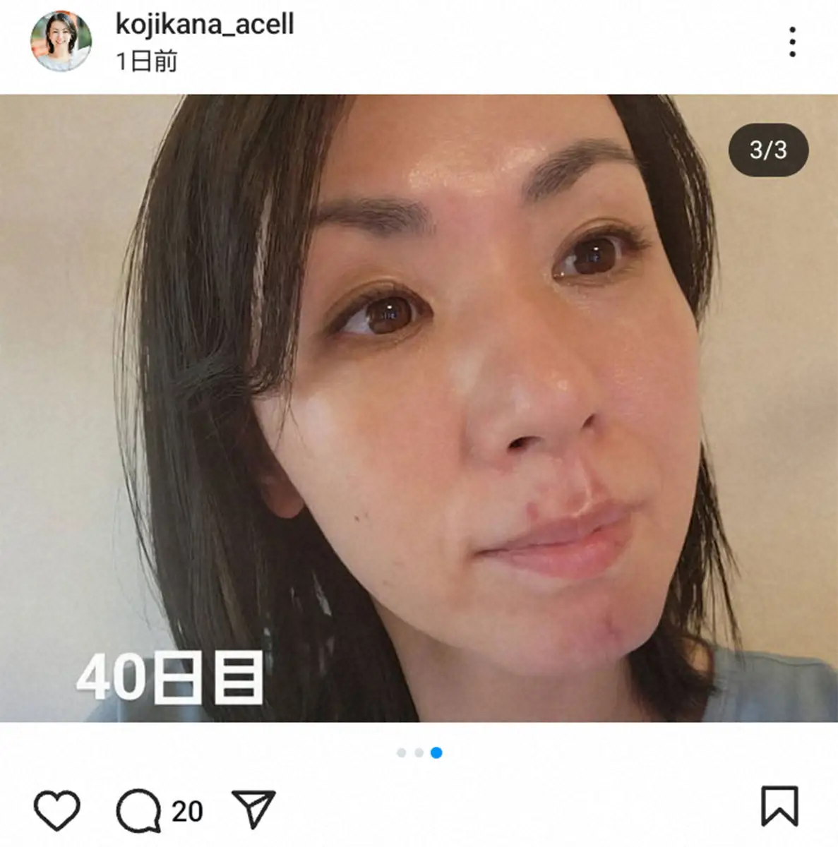 【画像・写真】犬に顔かまれ30針縫った小島可奈子　ケガ後40日目の経過報告　“傷残る”に今後は保険外診療も