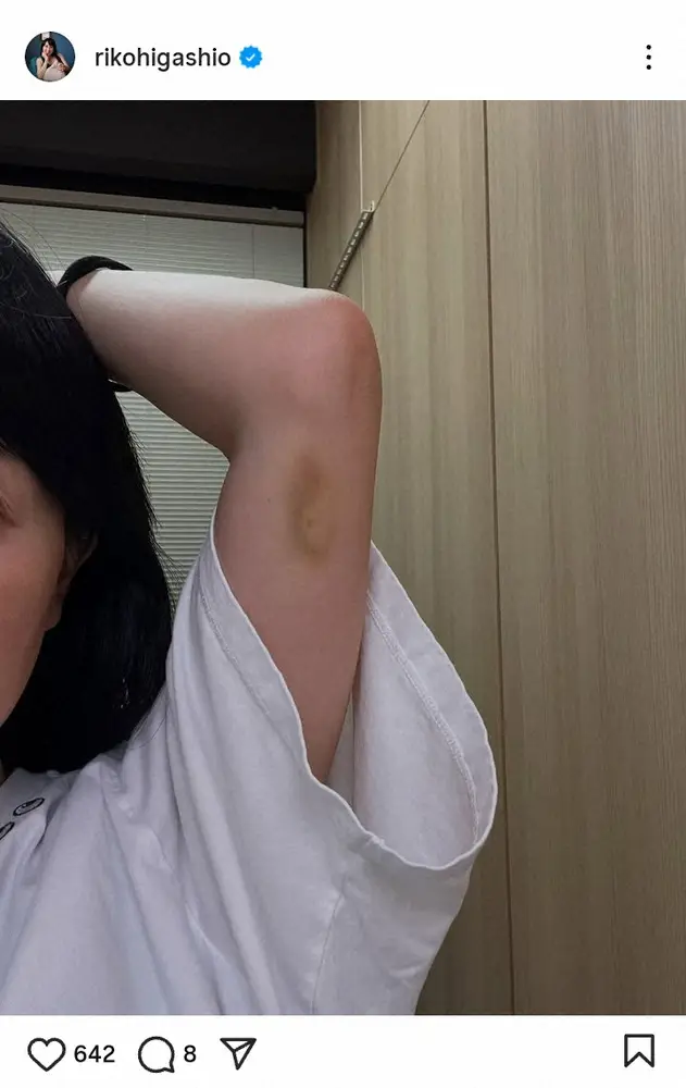 【画像・写真】東尾理子　「息子の野球練習に付き合って…軽く触れたと思ってたら」腕には…「痛そう」「お大事に」の声