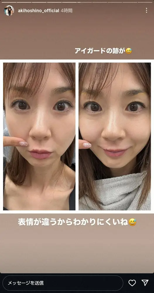 【画像・写真】ほしのあき「人中短縮レーザーで1ミリ短く」整形ビフォアフ写真公開「唇Cガールになりたい」