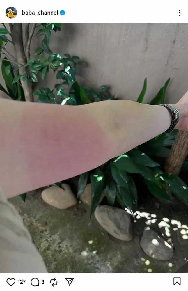 【画像・写真】馬場典子アナが蚊に悲鳴「異常に腫れてしまいます」真っ赤になった腕の写真公開「これは最大サイズ」