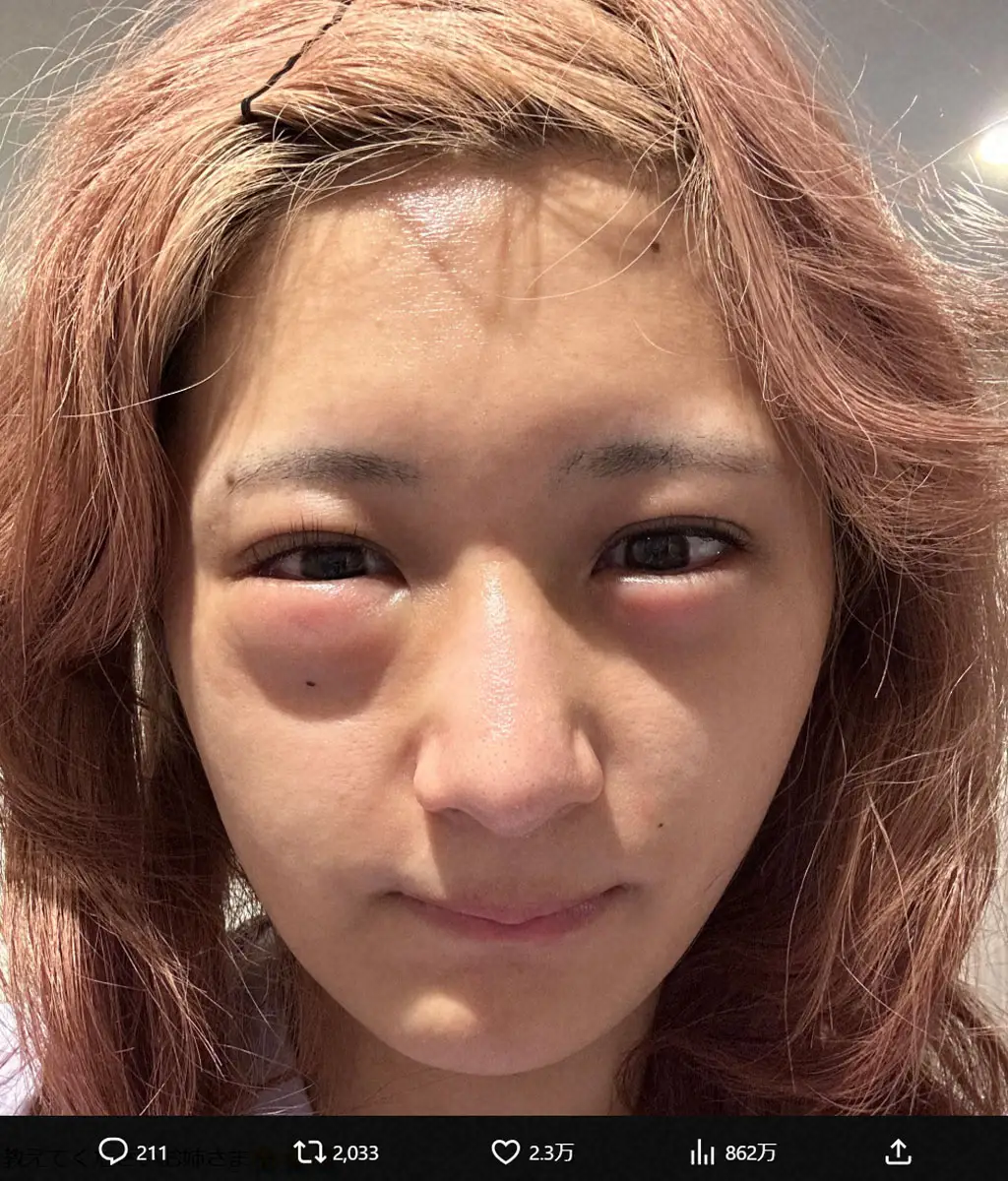 【画像・写真】しなこ　目の腫れの原因は「新しいコスメ」だった…化粧品トラブルに呼びかけ「30分とかでブワーって」