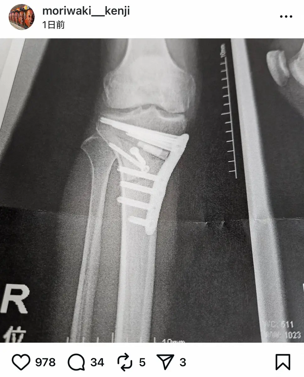 【画像・写真】森脇健児　痛々しい…術後右膝レントゲン写真公開　赤坂ミニマラソン激走一夜「万全には程遠い」