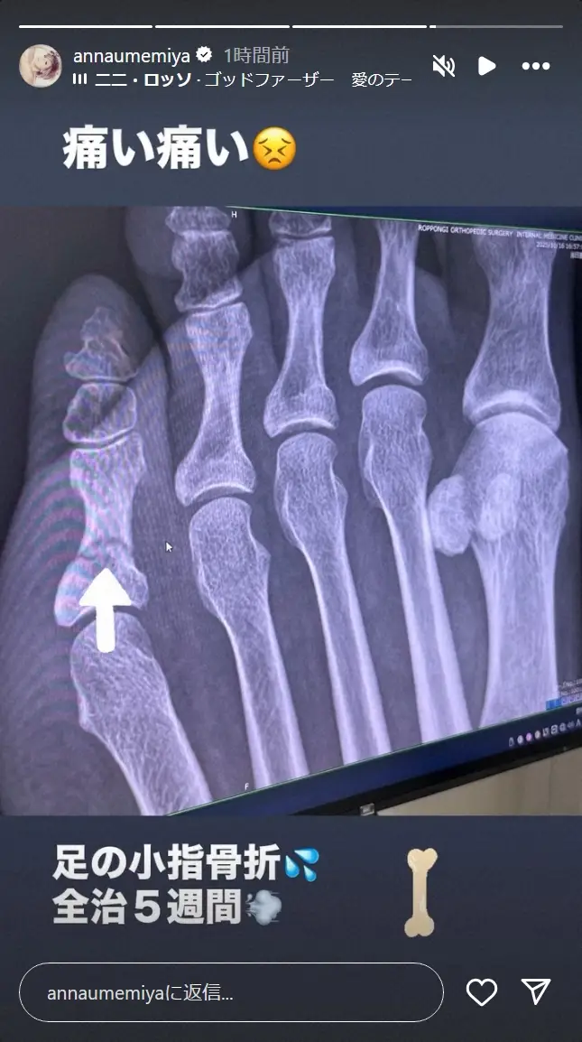 【画像・写真】梅宮アンナ　足の小指骨折で全治5週間　レントゲン写真添え公表「痛い痛い」