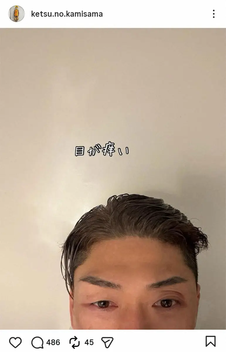 【画像・写真】樽美酒研二　原因不明のじんましん　とうとう症状が顔にも…今年のSASUKE欠場も報告