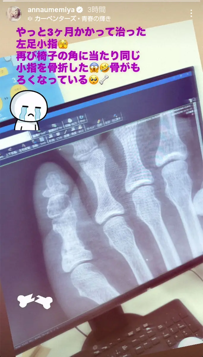 【画像・写真】梅宮アンナ　またも骨折を報告…昨年10月に左足小指骨折　ようやく完治も「骨がもろくなっている」