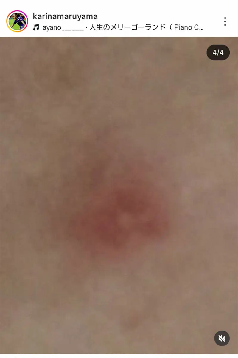 【画像・写真】丸山桂里奈　「マダニに噛まれ、皮膚科へ」庭の手入れ中に悲劇「まさかいるなんて」今後の方針は