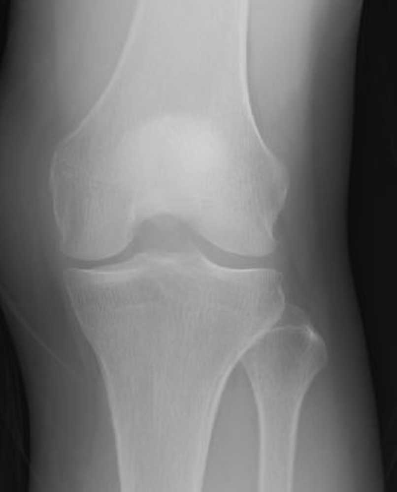 （１）正常な膝。軟骨の減りも、軟骨が棘（とげ）のように変形する骨棘（こつきょく）もない