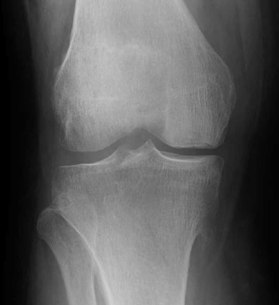 （２）変形性膝関節症になりつつある膝。大腿骨の内側の骨が少しへこみ、軟骨が薄くなりつつある