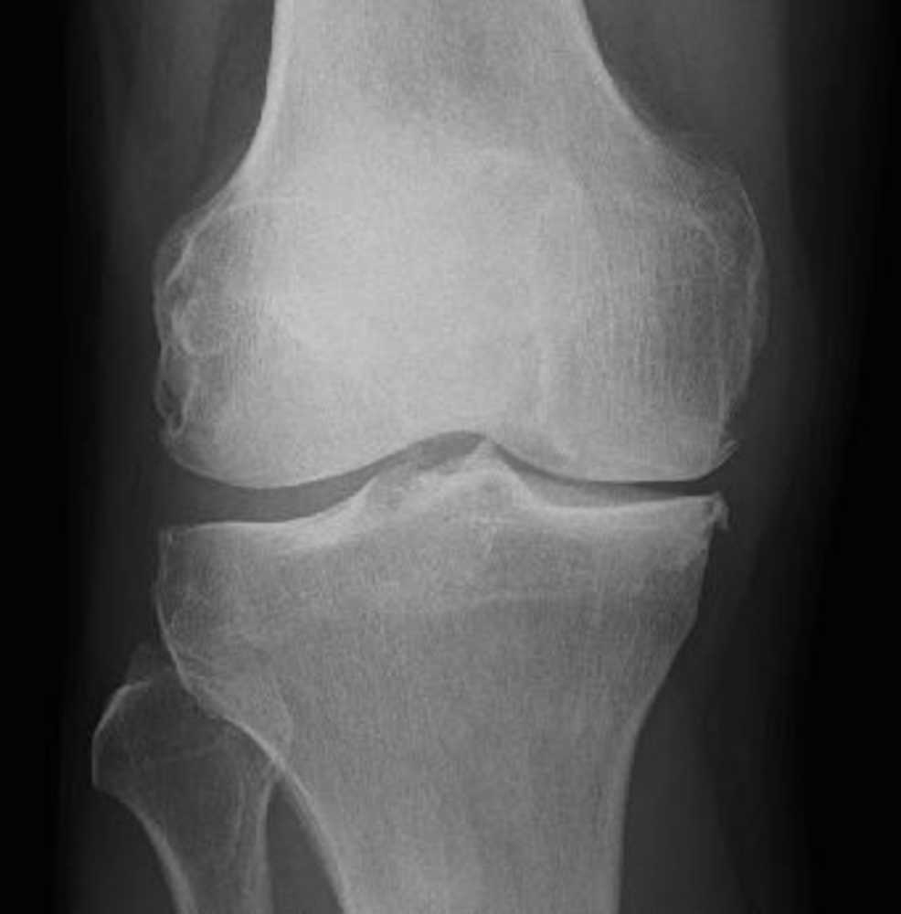 （３）変形性膝関節症を患った膝。膝内側にはっきりした骨棘があり、軟骨が減って関節の隙間が狭くなっている