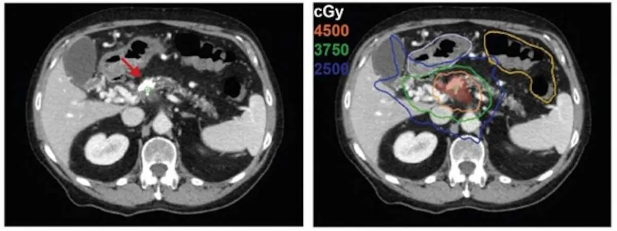 【画像・写真】進歩する放射線治療　がん細胞のDNAにダメージ　細胞の死滅を促す集学的治療の一角